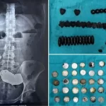 hindistanda-cinkonun-beden-gelistirdigini-dusunen-halterci-39-madeni-para-ve-37-miknatisi-yuttu-vRGZVdxu.jpg